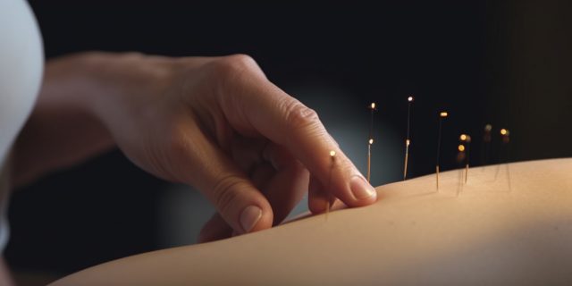 Acupuncture treatment with needles inserted into skin, hands resting on top